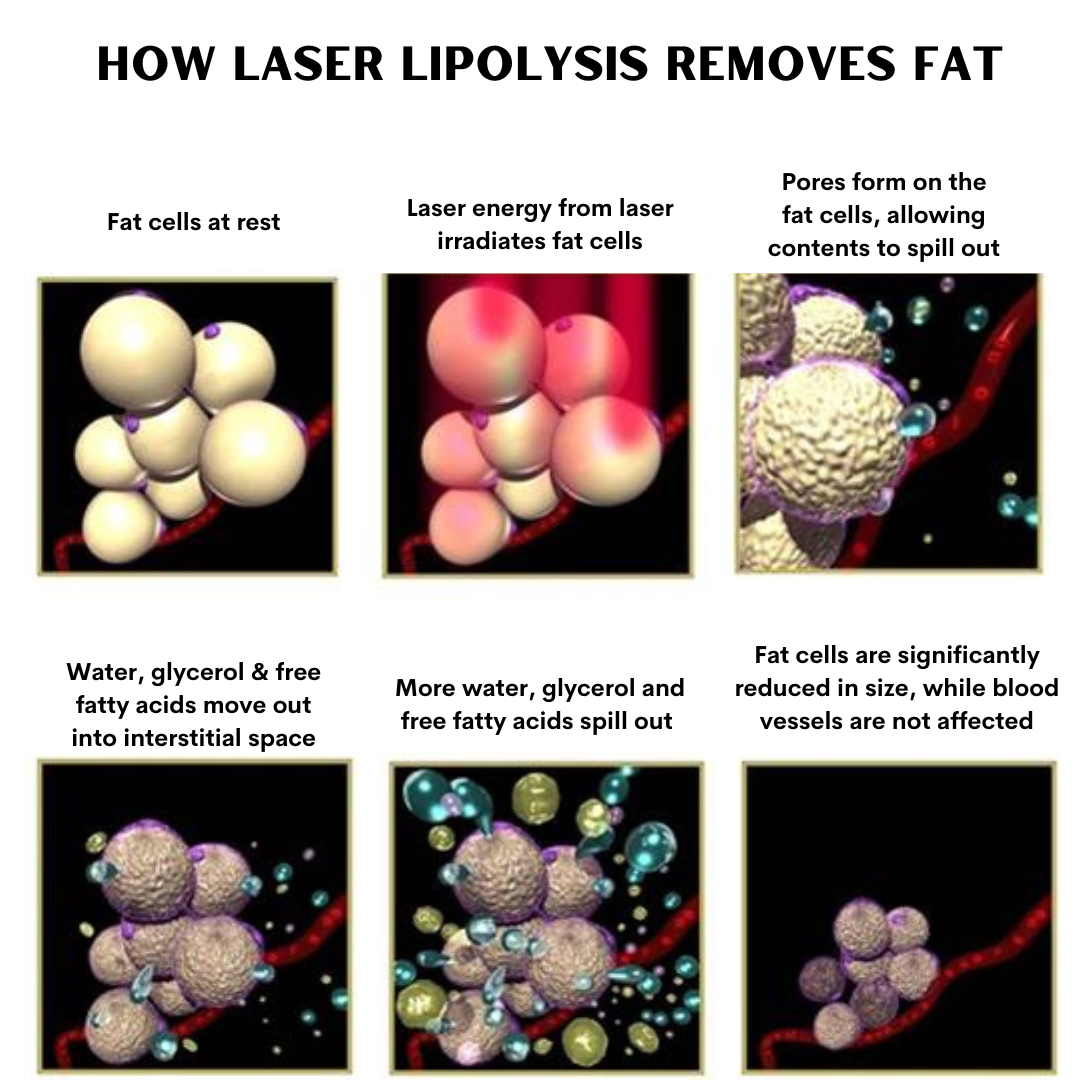 ELORA™ 12D 980nm Diode Lipo Laser