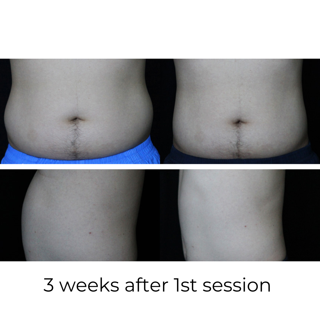 SCULPT-ASSURE 1060nm Diode Laser