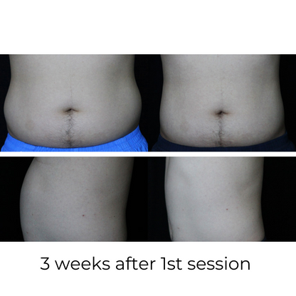 SCULPT-ASSURE 1060nm Diode Laser