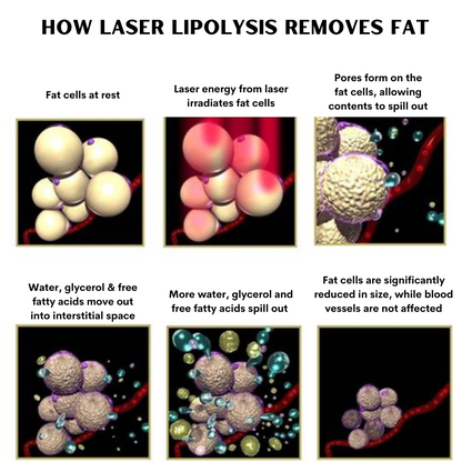 ELORA™ 12D 980nm Diode Lipo Laser